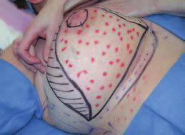 C, bell-shaped curve based on the inframammary fold is marked with the nipple-areola complex