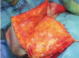 D, fter injection of tumescent solution, the bell-shaped inferior pedicle is