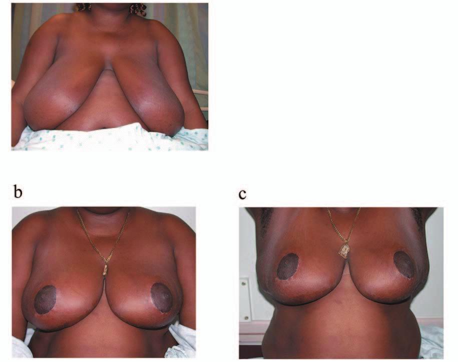 B C Figure 7. Ptosis and very large reduction., Preoperative view of a 24-year-old woman with a sternal notch-to-nipple distance of 50 cm.
