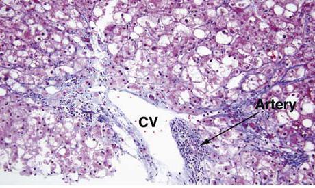 Centrizonal Arteries and Microvessels in Non-alcoholic Steatohepatitis (Gill, Am J Surg Pathol 2011)