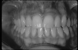 diagnosed in mixed dentition Early treatment appears