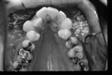 bonded Works by expanding the midpalatal suture