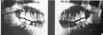 Interferences Anterior crossbites Posterior Crossbites Interference with Normal Eruption Habit Therapy Ankylosis Mesiodens or Supernumerary Midline Diastema Large diastema can lead to crowding or