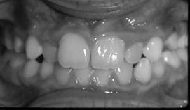 Pre-Tx Post-Tx Removable Palatal Expander Patient compliance needed It doesn t fit even if