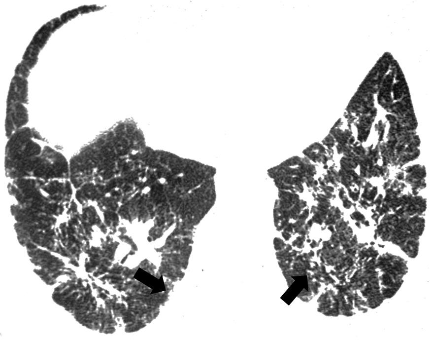 Axial HRCT scan of the chest with lung window settings, showing diffuse reticular opacities with traction bronchiolectasis.