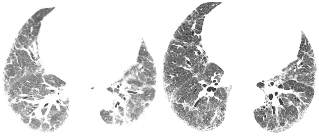 Usual interstitial pneumonia: typical, possible, and inconsistent patterns A B Figure 6. Axial CT scans of the chest with lung window settings.