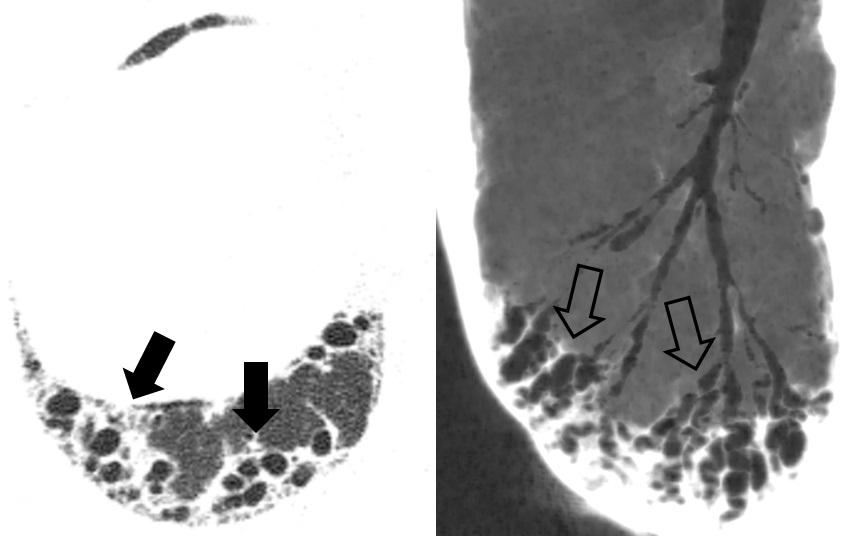 In B, a new scan, taken during an adequately performed inspiratory maneuver. A B A B Figure 7. In A, axial HRCT scan of the chest with lung window settings.