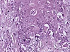 to center of Lesion Practice point: The epithelioid cytology is more common in childhood but is unusual in adults and may point to a melanoma when present Pagets spread phenomenon Melanoma