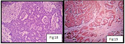 histopathologically diagnosed as Granulosa cell tumor, two cases turned out to be primary