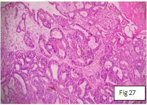 ENDOMETRIOID CARCINOMA Figure 27 Back-to-back glands lined by columnar cells with stratified hyperchromatic nuclei (H&E x 10X) DISCUSSION The ovarian tumors are not a single entity, but a complex