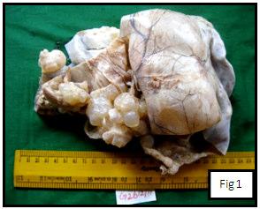 BENIGN MUCINOUS CYSTADENOMA Figure 1: Cystic mass filled with mucinous material BENIGN PAPILLARY SEROUS CYSTADENOMA Figure 2: