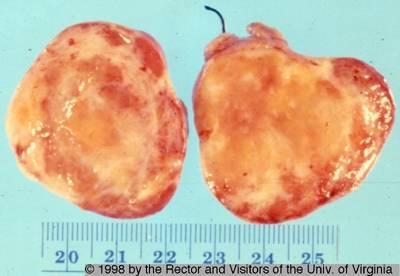 Solid tumor with variegated