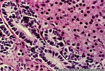 Sertoli-Leydig cell tumors Tubules lined