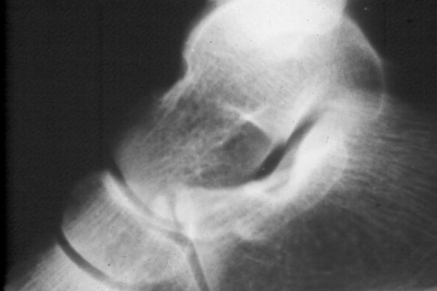 Calcaneus : Anterior process avulsion fracture Pain post sprain Easily missed on X-raysX High