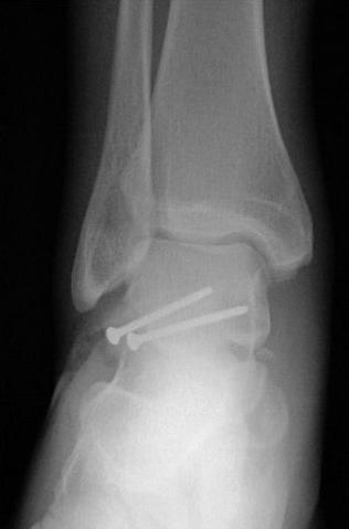 Treatment : lateral process # Acute - nondisplaced: cast treatment NWB Acute - displaced: ORIF or