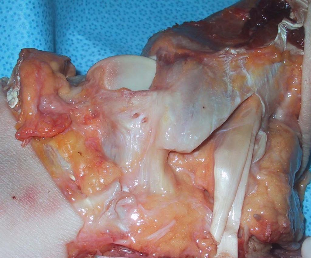 Lateral Ligaments : fibular