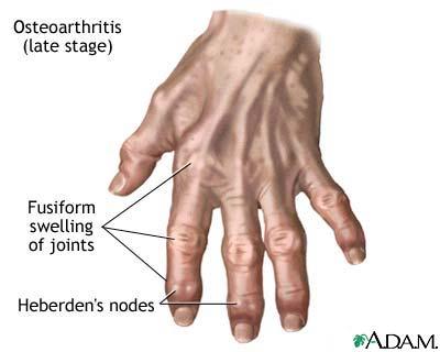 Wear and tear arthritis Be aware of pain in joints after an activity Treat