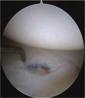 MRI or computed tomography (CT) with arthrography may show a leak of contrast through the TFCC as a sign of the degenerative central perforation tear of the TFCC seen at arthroscopy.