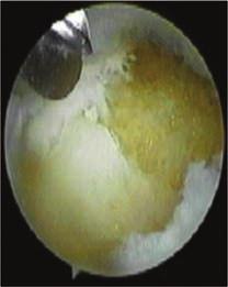 Figure 5: TFCC Debridement of the Loose Components of the Central Perforation Tear, Without Destabilising the Peripheral Fibres Surgical Technique Our Preferred Method Wrist arthroscopy is performed