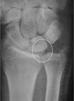 Figure 7: Postoperative X-ray after Arthroscopical Partial Ulnar Head Resection bone left at the end of an arthroscopic wafer leaves a lot of enzymes and substances from the cancellous bone that take