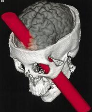 The tamping iron went in under his left cheek bone and completely out through the top of his head, landing about 25 to 30 yards behind him. Phineas Gage (1848) Yes he LIVED!