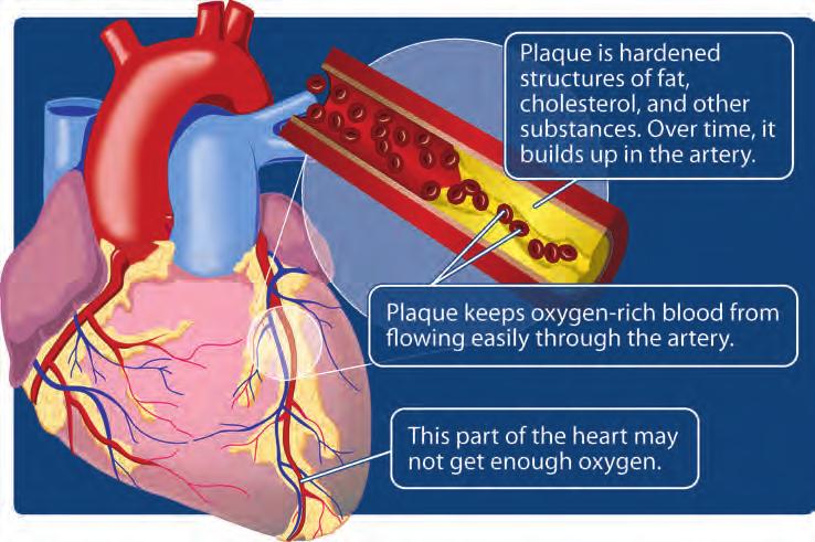 Understanding Your Disease What Is Coronary Heart Disease? This picture shows what your coronary heart disease may look like.