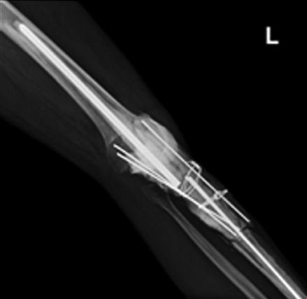 Anteroposterior radiograph 3 months following placement in the defective area of a temporary space-occupying implement comprised of bone cement containing vancomycin (B).