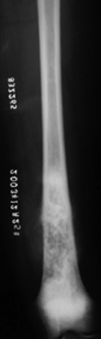 1A 1B 1C Figure 1: Preoperative anteroposterior (A) and lateral (B) radiographs. Anteroposterior radiograph 7 years postoperatively showing fusion of the femur with the prosthesis with the allograft.