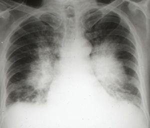 Acute pulmonary oedema: alveolar oedema.