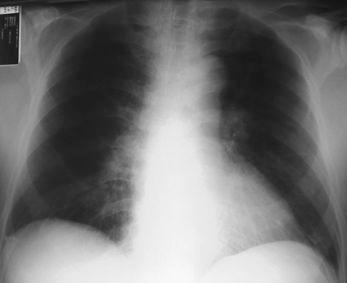 Male,45 years old, acute and severe dyspnea,