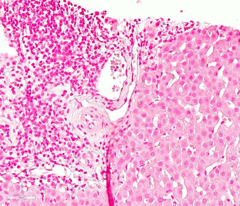 40x CK7 Case 3 pathologic diagnosis Liver, core needle biopsy: Features consistent with primary biliary cirrhosis/primary biliary cholangitis; see comment.