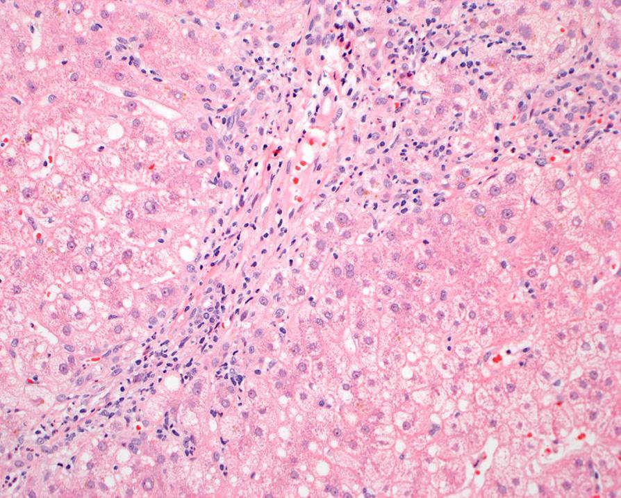 Elevated IgG4 (226) Zhang L, et al. IgG4+ plasma cell infiltrates in liver explants with primary sclerosing cholangitis. Am J Surg Pathol. 2010 Jan;34(1):88-94. Koyabu M, et al.