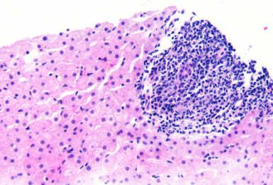 Diagnostic criteria Emphasize Patchy distribution and range of histologic