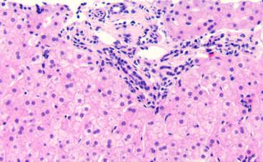 clinical history 55 year old woman with elevated LFT Liver biopsy