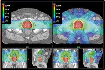 candidate Proton Therapy Pros Lower integral dose than IMRT Higher radiobiologic effect Cons Limited