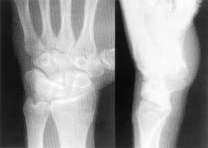 RESULTS Short- and mid-term results Scaphoid reconstruction failed in one patient owing to a technical error. The pisiform was placed too far anteriorly and did not articulate with the radius.