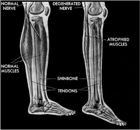 muscle Results in a bending of a joint Foot drop is a common contracture Fingers, wrists