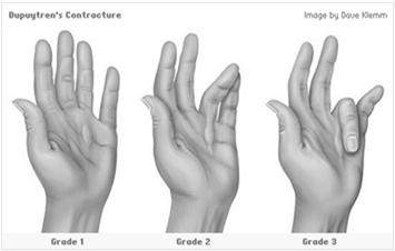 Contracture can occur for many reasons, such as paralysis, muscular atrophy, and forms of muscular dystrophy. Fundamentally, the muscle and it s tendons shorten, resulting in reduced flexibility.
