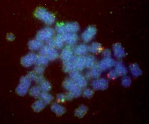 MYC BCL2 Double hit lymphomas Cytogeneticist: