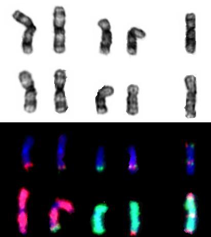 MYC BCL2 Double hit lymphomas Whole chromosome painting Composite image of key abnormal