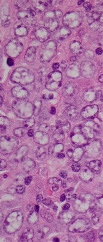 HHV8-associated MCD Primary effusion lymphoma Diffuse large B cell lymphoma, not