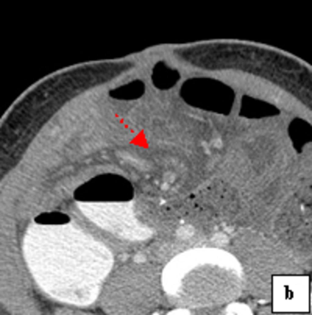 Fig.: Fig 8: Mesojejunal hernia occurring in a 32-year-old-woman 2 years after gastric bypass.