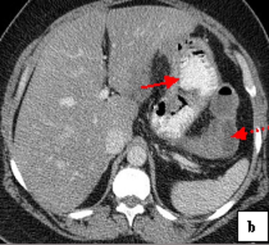 Fig.: Fig 5: Transmesocolic hernia occurring in a 44-year-old woman, 1 month after the LRYBGP.