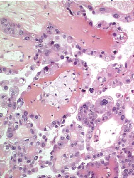 carcinomas and are generally unilateral solid masses with