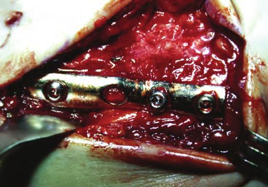Open reduction internal fixtion of the fibula. Figure 1J.