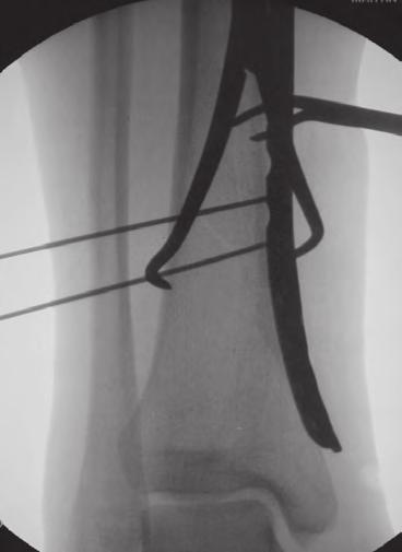 Percutaneous delivery of precontoured distal tibial plate.