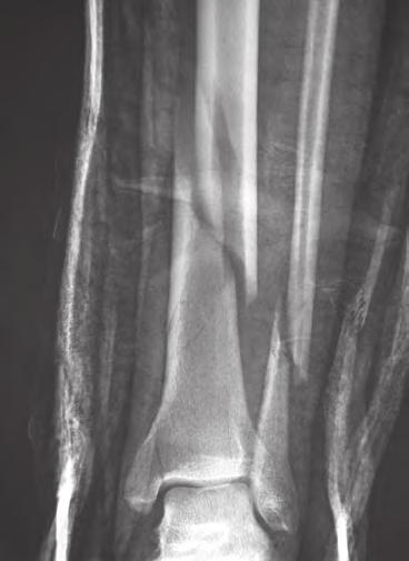 Anteroposterior view of distal tibial fracture with associated Weber type C fibular