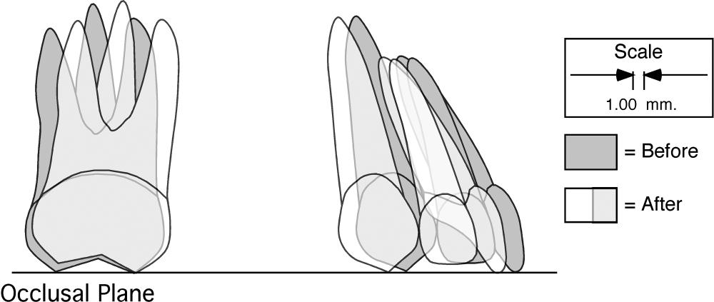 Graphic depiction of the mean tooth movements for the canine and molar teeth during the observation period.