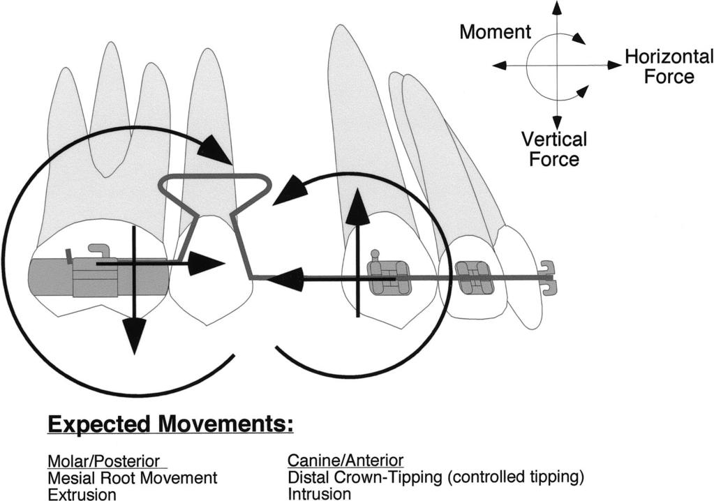 TOOTH MOVEMENTS AND DIFFERENTIAL MOMENT CLOSING LOOPS 273 FIGURE 2.