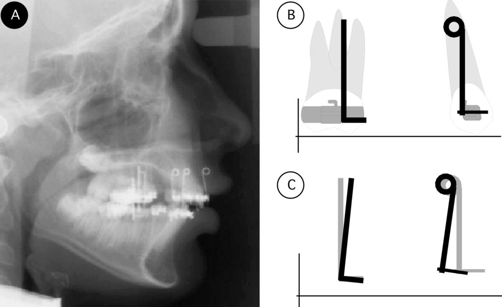 274 KUHLBERG, PRIEBE FIGURE 4. Example of tooth position locating devices. (A) Example of lateral cephalometric radiograph with devices in place.